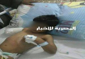 طفل يفقد ذراعه بسبب إهمال طبيب بمستشفى سمالوط العام فى المنيا