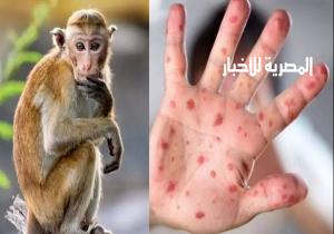 "المصل واللقاح": لا داعي للقلق من جدري القرود