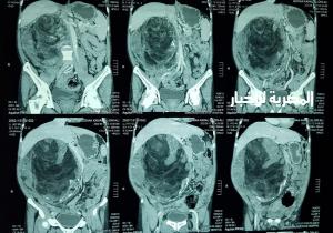 استئصال ورم يزن 7 كيلو من جسد مريض بمركز جراحة الجهاز الهضمي بالمنصورة