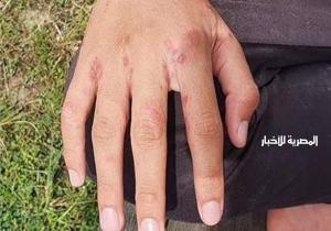 الدكتور أمجد الحداد: متلازمة فيكساس ليس له علاج وغير معد ويصيب الرجال أكثر من النساء
