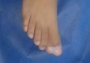 إصلاح عيب خلقي بالقدم اليمني وإزالة إصبع زائد لطفل 4 سنوات بجنوب سيناء