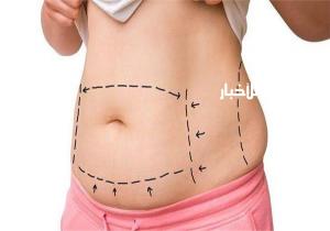 معلومات هامة عن جراحة تجميل البطن الكاملة